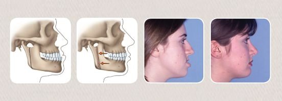 protruding jaw