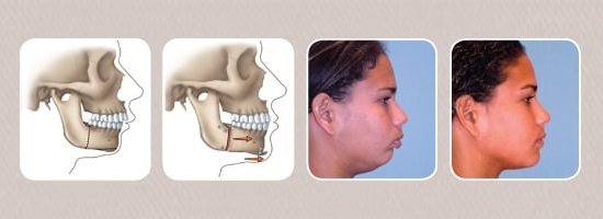 weak chin