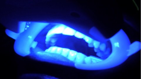 Clareamento Laser 3 480x270