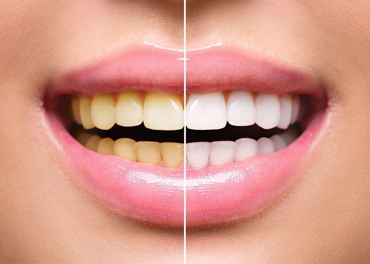 clareamento dental min