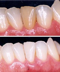 clareamento dente escuro