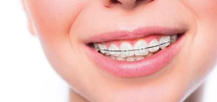 Tratamento Ortodôntico o que saber antes de começar