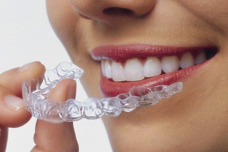 invisalign