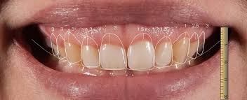 gengivoplastia