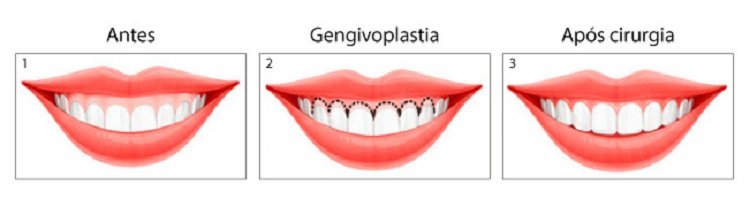gengivoplastia passos